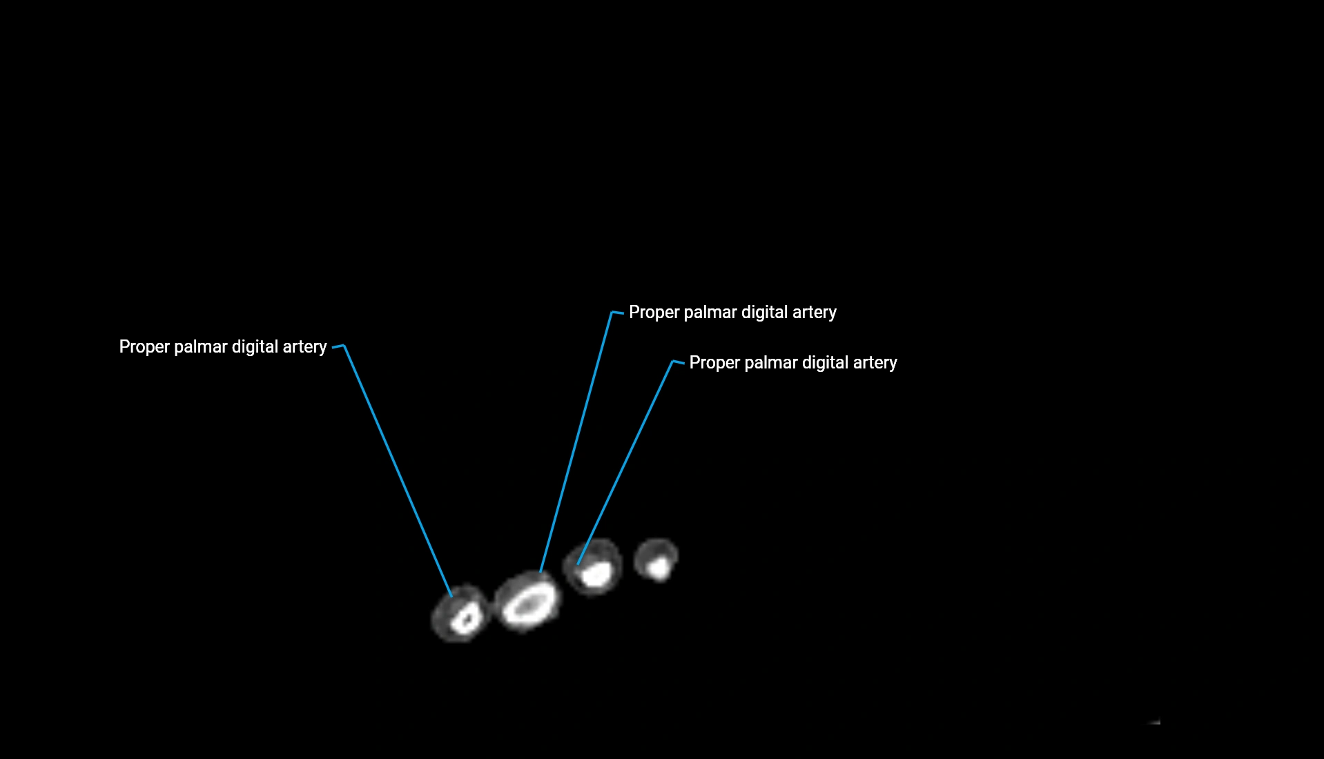 CTA upper limb axial cross sectional anatomy labelled image 21 (2).webp